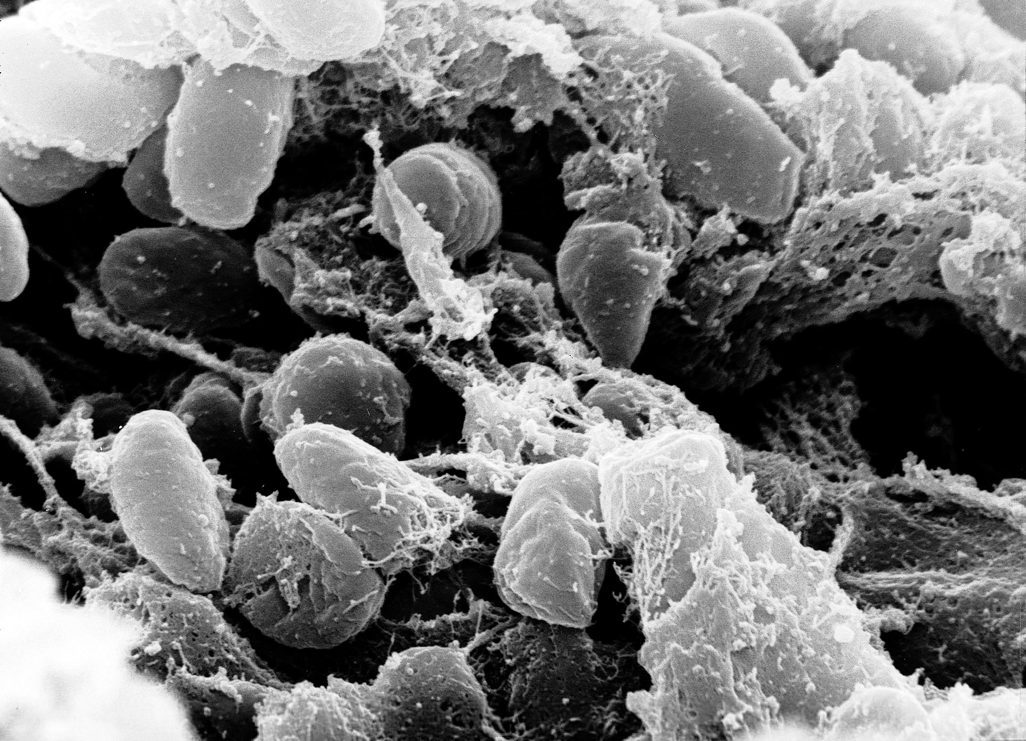 Qué es la peste neumónica y cuáles son sus riesgos para la salud pública